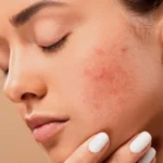 5 Tips on How to Treat Acne on Dry Skin